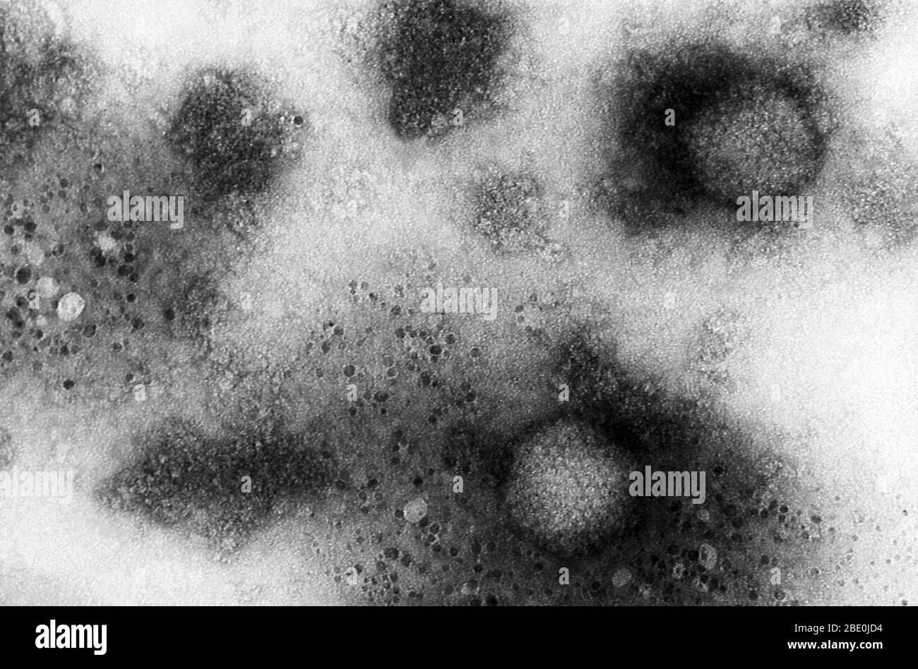 Transmission Electron Micrograph (TEM) zeigt einige der ultrastrukturellen Morphologie, die von zwei Adenovirus-2-Virionen gezeigt wird. Die Probe war pelletiert worden, wodurch die viralen Partikel vor der Betrachtung unter dem Mikroskop konzentriert wurden. Bei dieser hohen Vergrößerung sind die Kapseligkeit sichtbar, die in diesem Fall hexagonal geformt, auch Hexonen genannt, und die zusammen die äußere Hülle des Adenovirus, das als Capsid bekannt ist, umfasste. Diese Adenoviren zeigten eine Ikosaedrale Symmetrie, was bedeutet, dass die Form durch 12 Scheitelpunkte und 20 Facetten charakterisiert wurde. Jedes Virion war 70nm-80nm, A Stockfoto