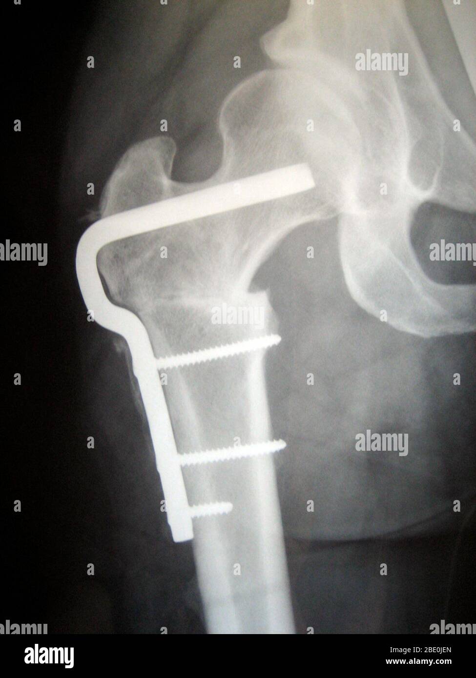 X-ray des femoralen Osteotomie hardware femoral Rotation von Hüftdysplasie zu korrigieren. Das Röntgenbild zeigt die rechte Hüfte in einer Patientin Anfang der 30er Jahre. Stockfoto