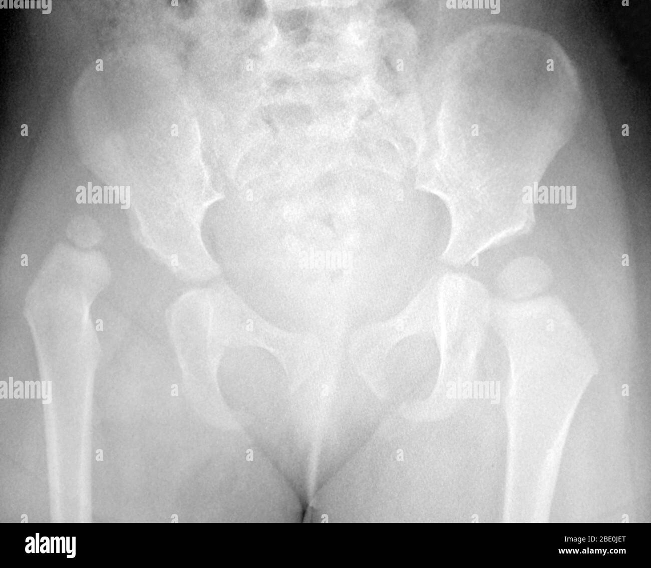 X-ray zeigt eine verschobene rechte Hüfte (auf Bild links) eines Kindes. Stockfoto