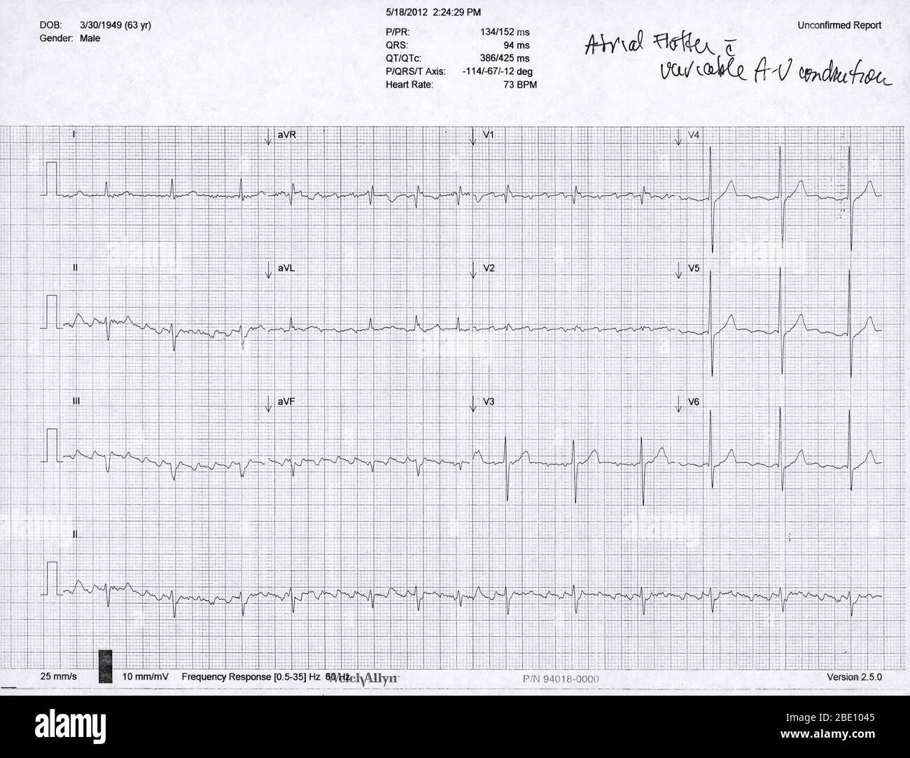 Elektrokardiogramm (EKG) eines 63-jährigen Mannes mit Vorhofflattern und AV-Leitung. Ein EKG misst das Pumpen der Herzkammern mit 12 externen Elektroden (I-III, V1-V6 und AVR, aVL und aVF) und zeichnet es als elektrische Wellen auf. Ein Flattern ist eine erhöhte Kontraktionsrate der oberen Herzkammern (Atrien), die als zahlreiche flache Wellen gesehen wird Stockfoto