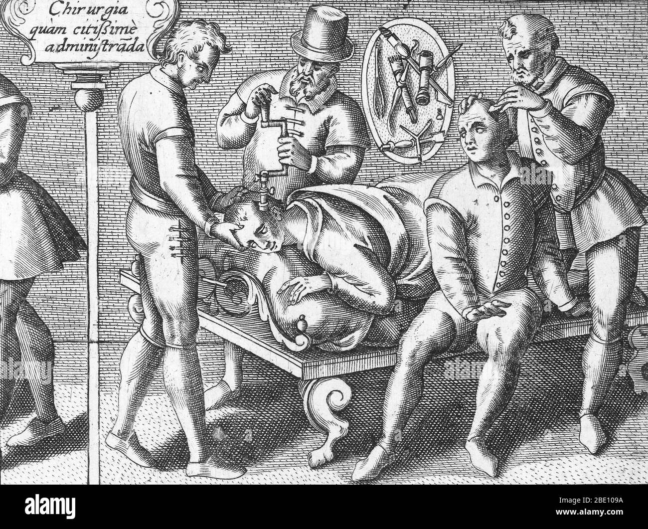 Trepanning wird durchgeführt, 1594. Ein Patient liegt still, während Trepaning auf seinem Schädel durchgeführt wird. Ein anderer ängstlich aussehender Mann sitzt neben ihm und ist bereit, sich der gleichen Operation zu unterziehen. Trepanning ist eine chirurgische Intervention, bei der ein Loch gebohrt oder in den menschlichen Schädel geschabt wird, wobei die Dura mater ausgesetzt wird, um Gesundheitsprobleme im Zusammenhang mit intrakraniellen Erkrankungen zu behandeln. Höhlenmalereien deuten darauf hin, dass die Menschen glaubten, dass die Praxis epileptische Anfälle, Migräne, psychische Störungen heilen würde und der Knochen, der trepanned wurde, wurde als Charme gehalten, um böse Geister fern zu halten. Trepanation wurde auch praktiziert Stockfoto