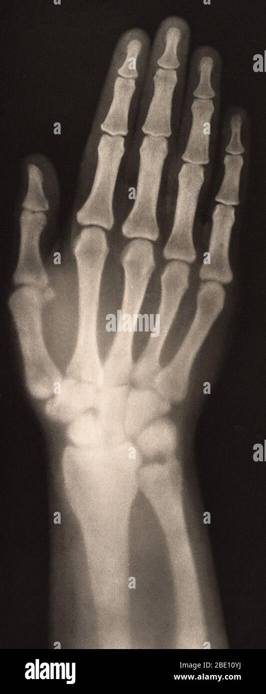 Historische Röntgenaufnahme einer Frauenhand, 1896. Aufgenommen von Josef Maria Eder (Österreicher, 1855-1944) und Eduard Valenta (Österreicher, 1857-1937). Tiefdruck. Eder war Direktor eines Instituts für grafische Prozesse und Autor einer frühen Geschichte der Fotografie. Mit dem Fotochemiker Valenta produzierte er im Januar 1896, weniger als einen Monat nachdem Wilhelm Conrad Rontgen seine Entdeckung der Röntgenstrahlung veröffentlicht hatte, ein Portfolio. Eder und Valenta's Volumen, aus dem diese Platte stammt, demonstrierten die magische Fähigkeit des Röntgenstrahls, die verborgene Struktur lebender Dinge zu offenbaren. Menschliche Hände und Füße, Fische, Frösche, ein Schnabel Stockfoto