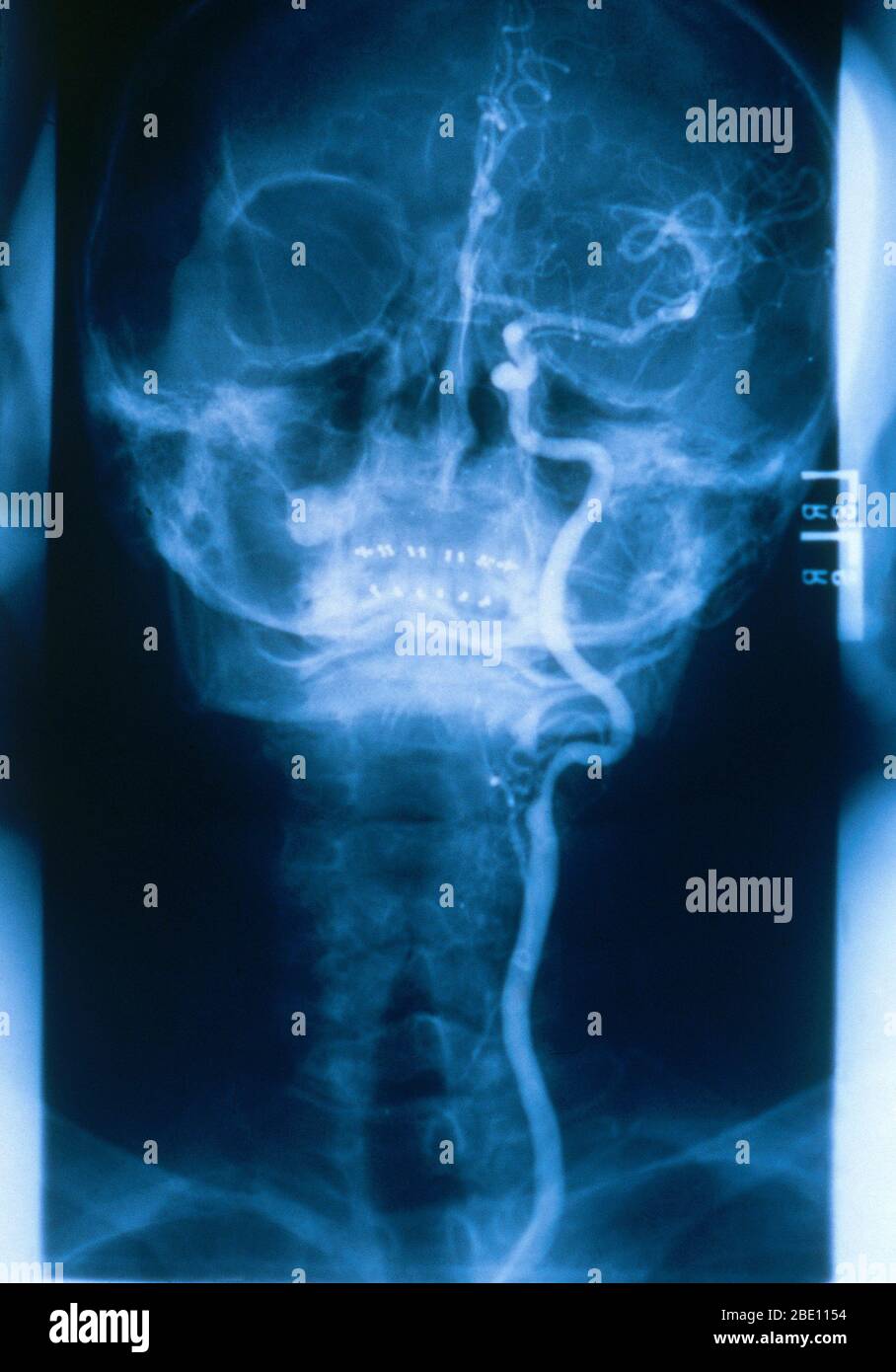 Medizinische Radiologie mit einem normalen linken Halsschlagader. Die gemeinsame Halsschlagader versorgt Hals und Kopf mit sauerstoffreichem Blut. Stockfoto