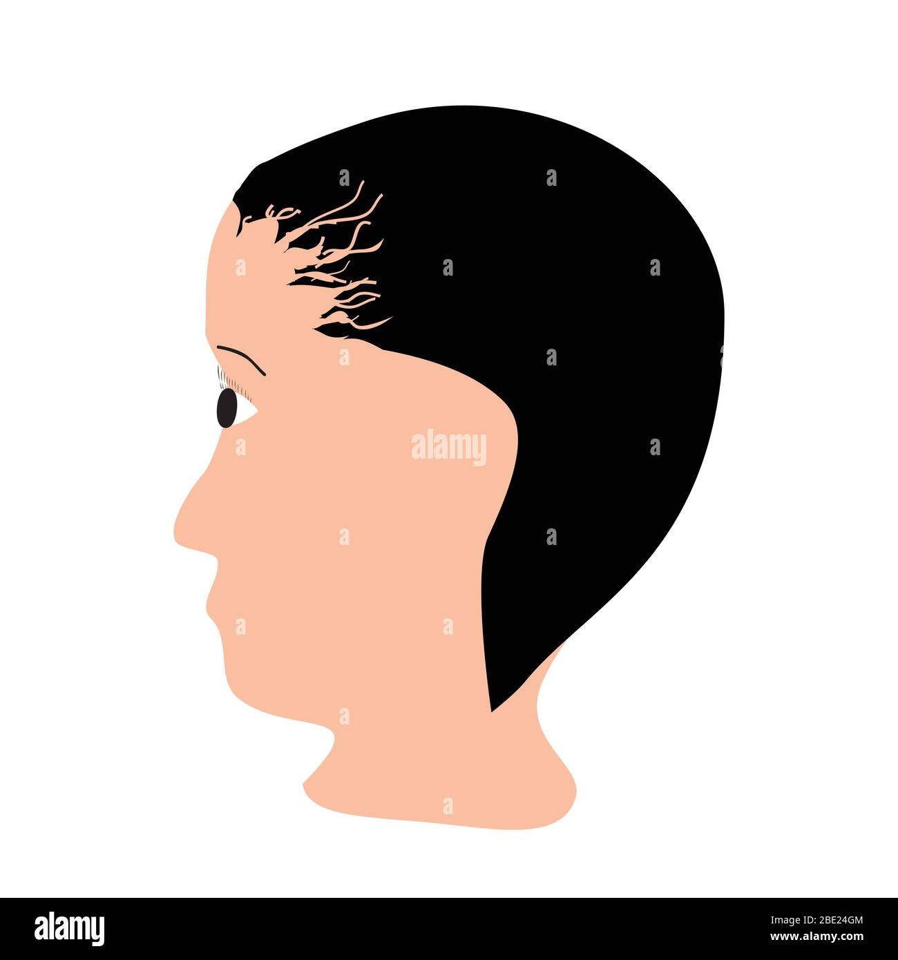 Alopezie Haar. Haarausfall am Kopf. Traktionsalopezie. Infografiken. Vektordarstellung auf isoliertem Hintergrund. Stock Vektor