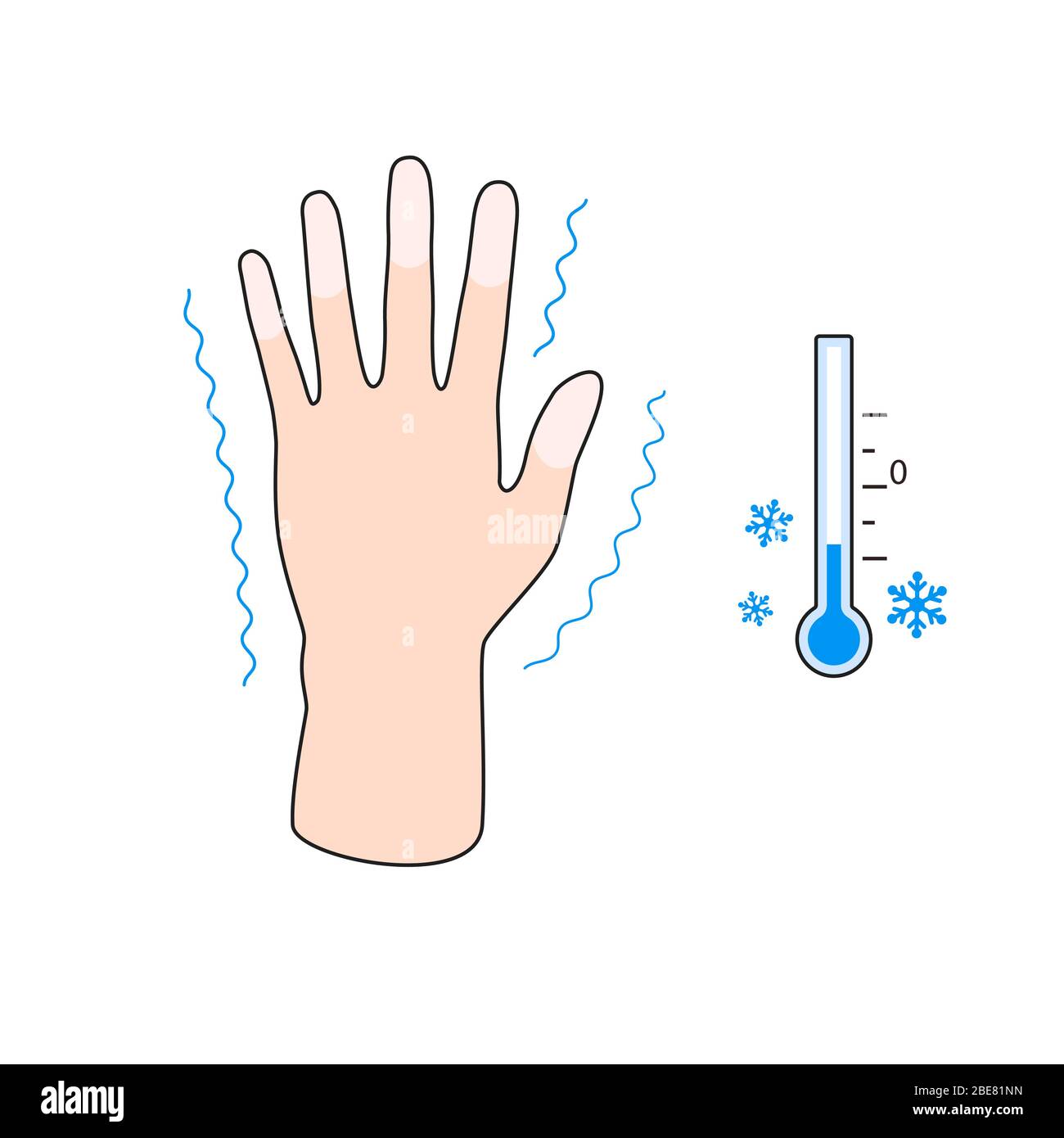 Erfrierungen. Hand mit Erfrierungen Symptome. Wirkung der Kälte auf die Finger des Menschen. Vektorgrafik Stock Vektor