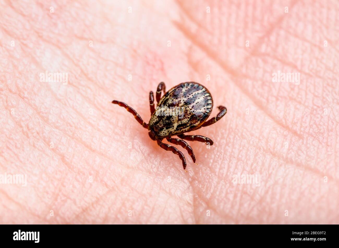 Lyme-Borreliose Infected Tick Insect Skin Biss , Encephalitis Virus oder Borreliose Infectious Dermacentor Arachnid Parasit Makro Stockfoto