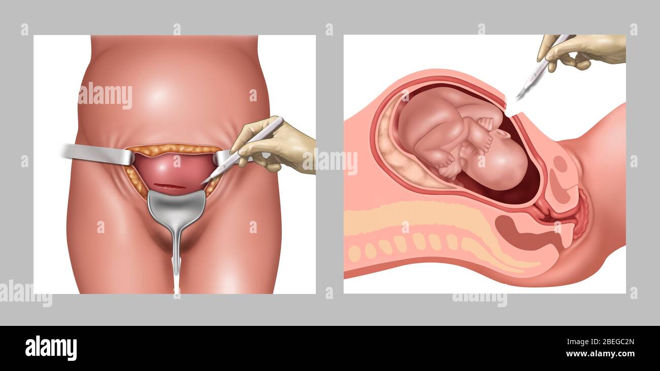 Abbildung eines Kaiserschnitts, der den Schnitt im Bauch zeigt, um die Gebärmutter freizulegen, die dann auch eingeschnitten wird. Stockfoto