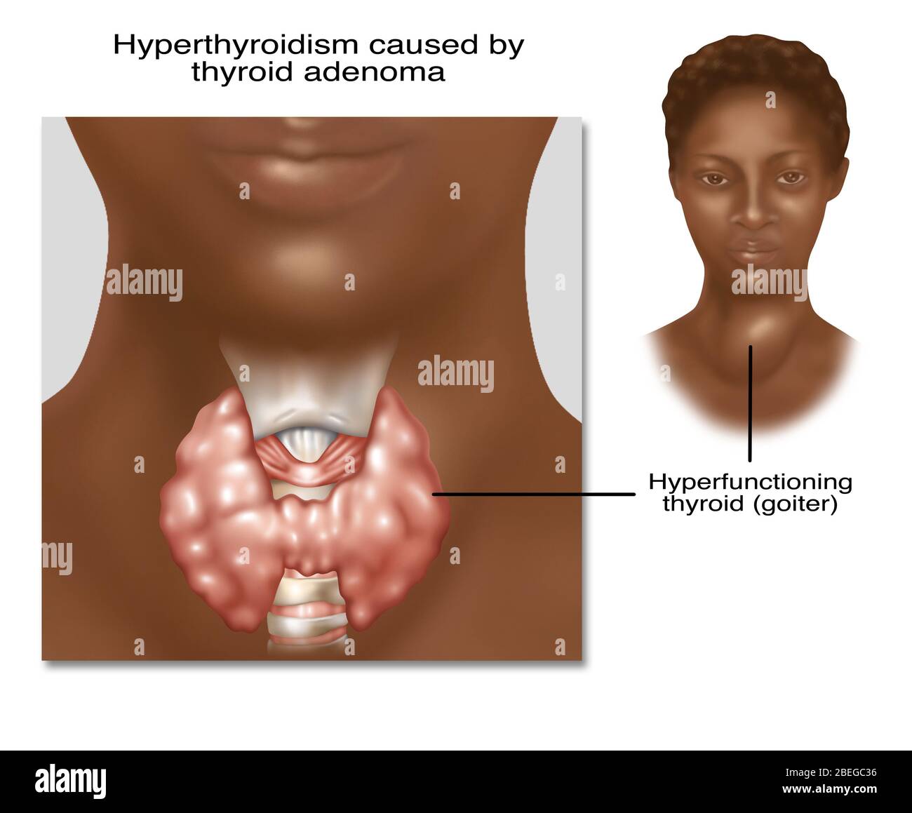 Hyperthyreose, Illustration Stockfoto