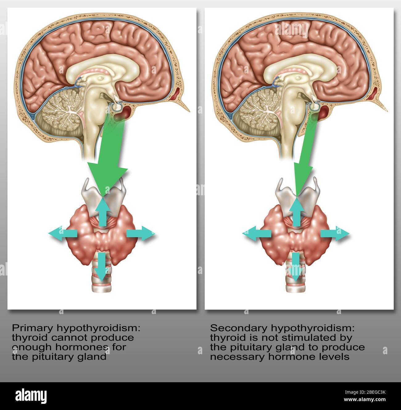 Primäre Und Sekundäre Hypothyreose, Abbildung Stockfoto