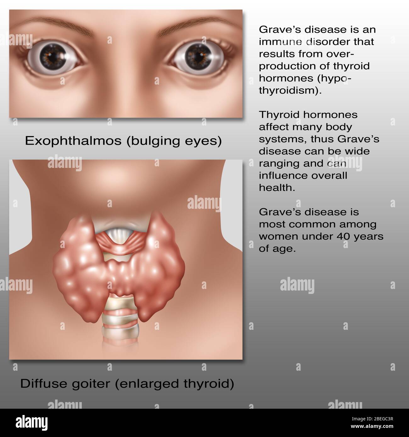 Gräber Krankheit, Illustration Stockfoto