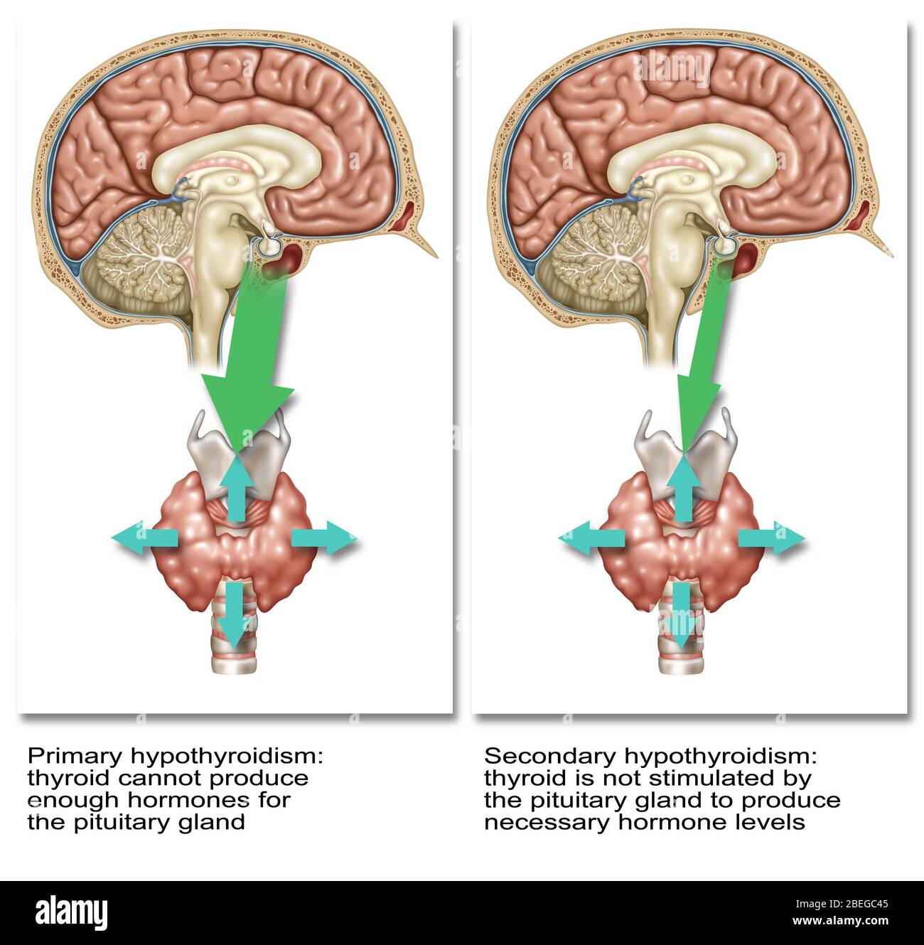 Primäre Und Sekundäre Hypothyreose, Abbildung Stockfoto