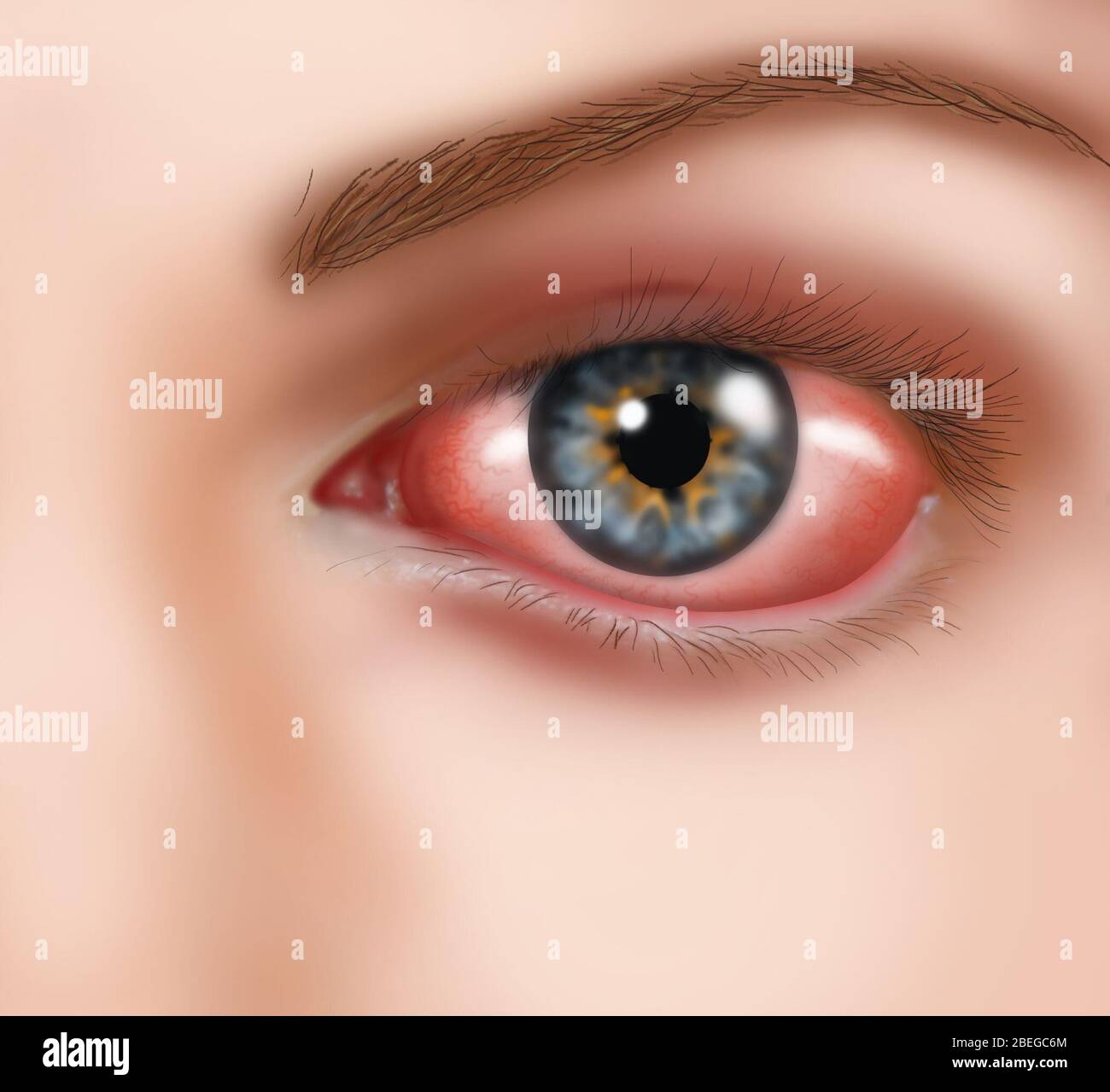 Illustration der allergischen Konjunktivitis. Bindehautentzündung ist eine Entzündung der Bindehaut (deckende Membran) des Auges. Symptome werden durch eine allergische Reaktion der Bindehaut auf eine Fremdsubstanz verursacht, häufige Auslöser sind Make-up, Kontaktlinsenlösung oder Pollen. Die Behandlung umfasst die Vermeidung der Ursache und Antihistaminaugen, um die Symptome zu lindern. Stockfoto