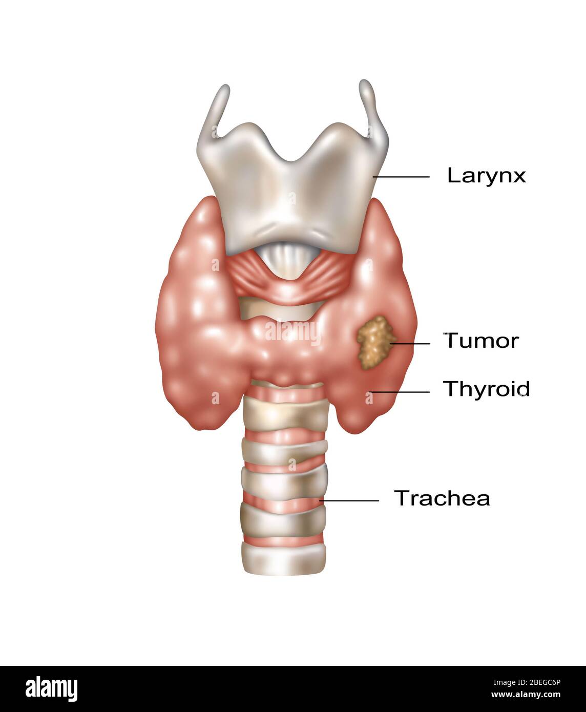 Abbildung zeigt die Lage von Kehlkopf, Schilddrüse und Luftröhre. Im unteren rechten Bereich der Schilddrüse ist ein bösartiges Wachstum zu beobachten. Stockfoto