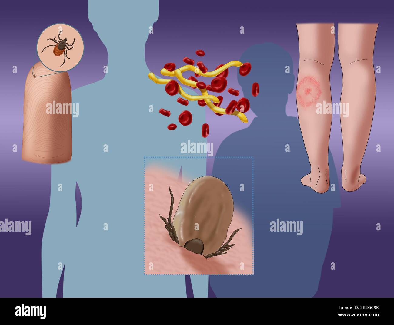 Lyme-Borreliose Infektionszyklus, Illustration Stockfoto