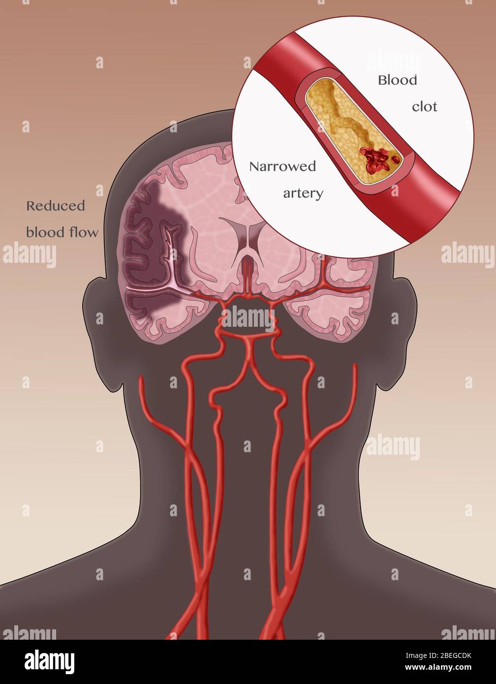 Ischämischer Schlaganfall, Illustration Stockfoto