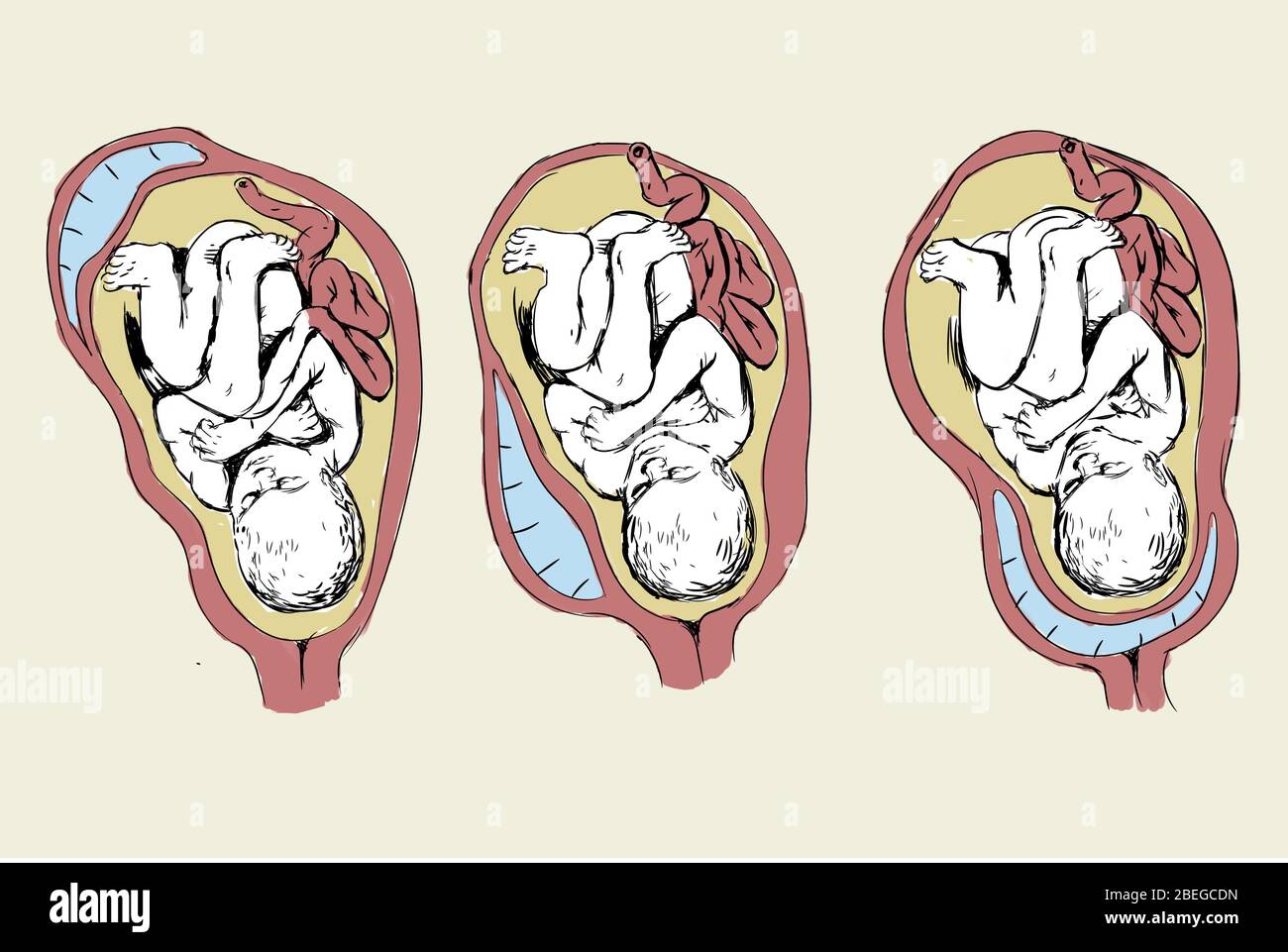 Placenta previa Fotos und Bildmaterial in hoher Auflösung Alamy