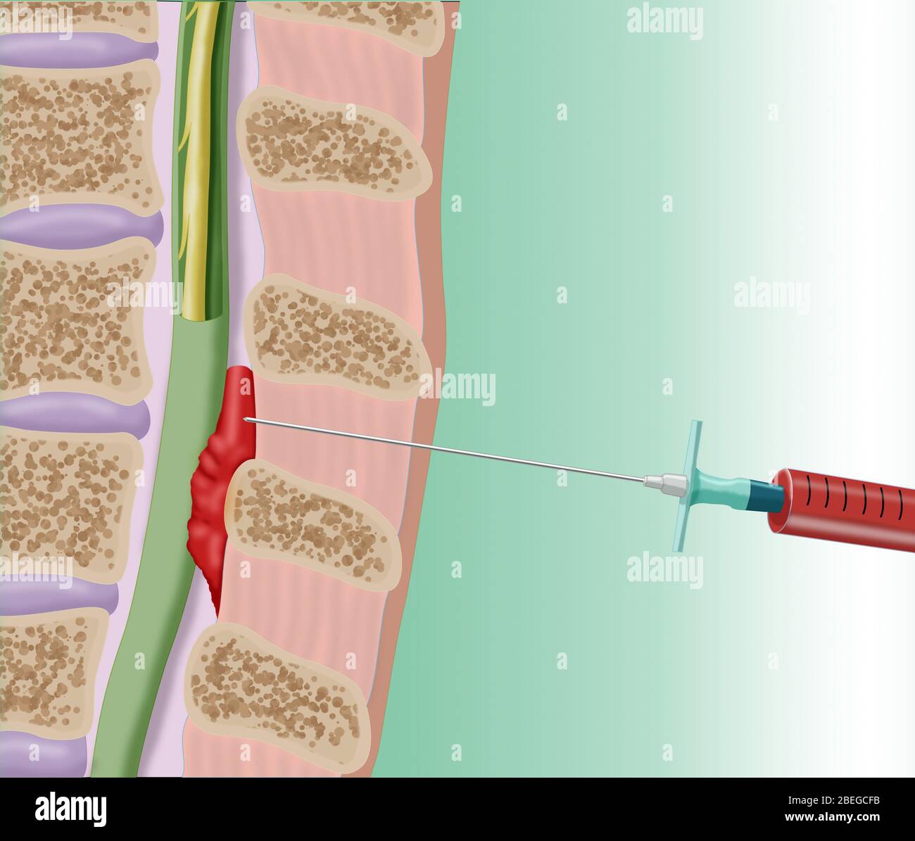 Epidurale Blutpflaster Verfahren, Illustration Stockfoto