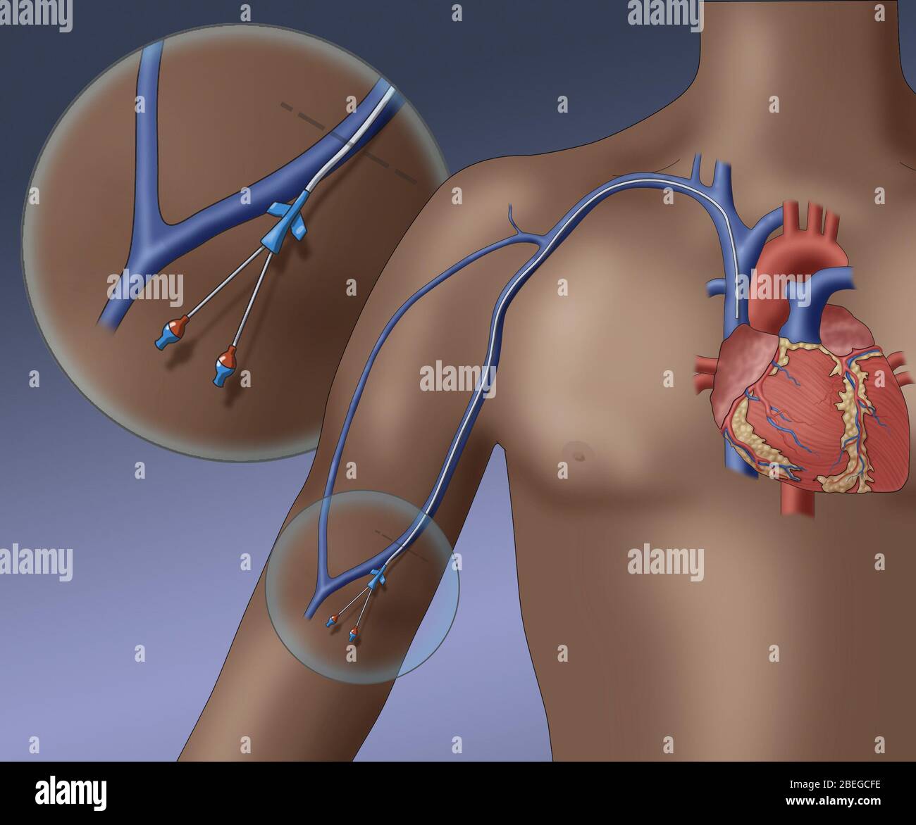 PICC intravenöses Gerät, Illustration Stockfoto