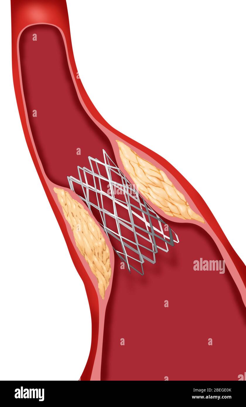 Angioplastik mit Stenting, 3 von 4 Stockfoto