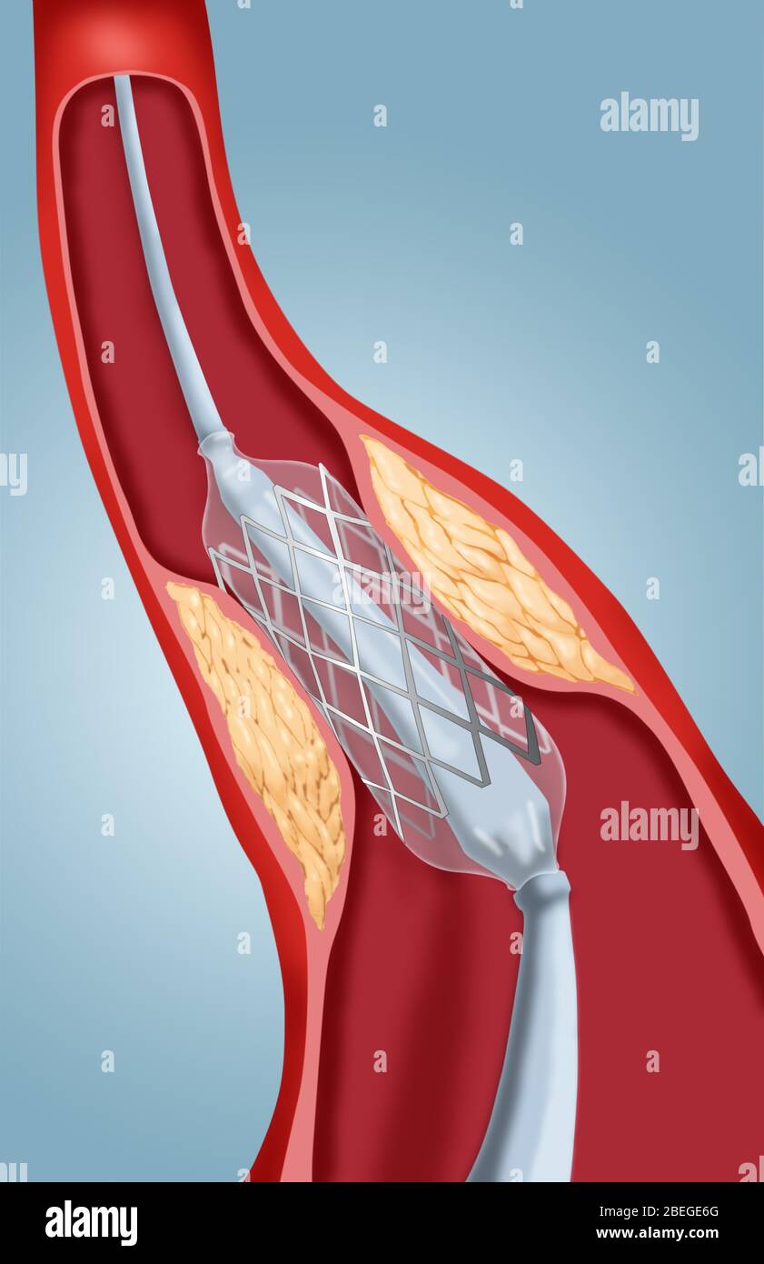 Angioplastik mit Stenting, 2 von 4 Stockfoto