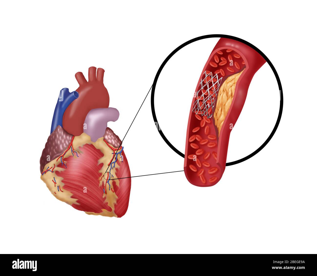 Angioplastik mit Stenting, 4 von 4 Stockfoto