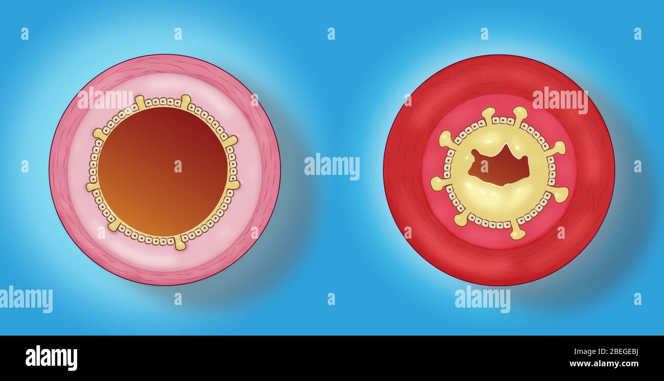 Bronchitis Stockfoto