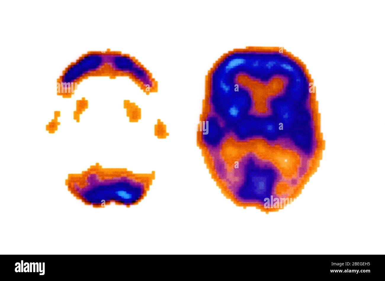 Normale und Alzheimer Gehirn Scans Stockfoto