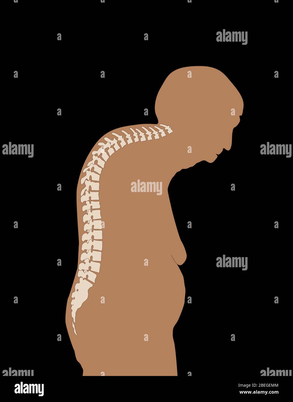 Dowager’s Hump Stockfoto