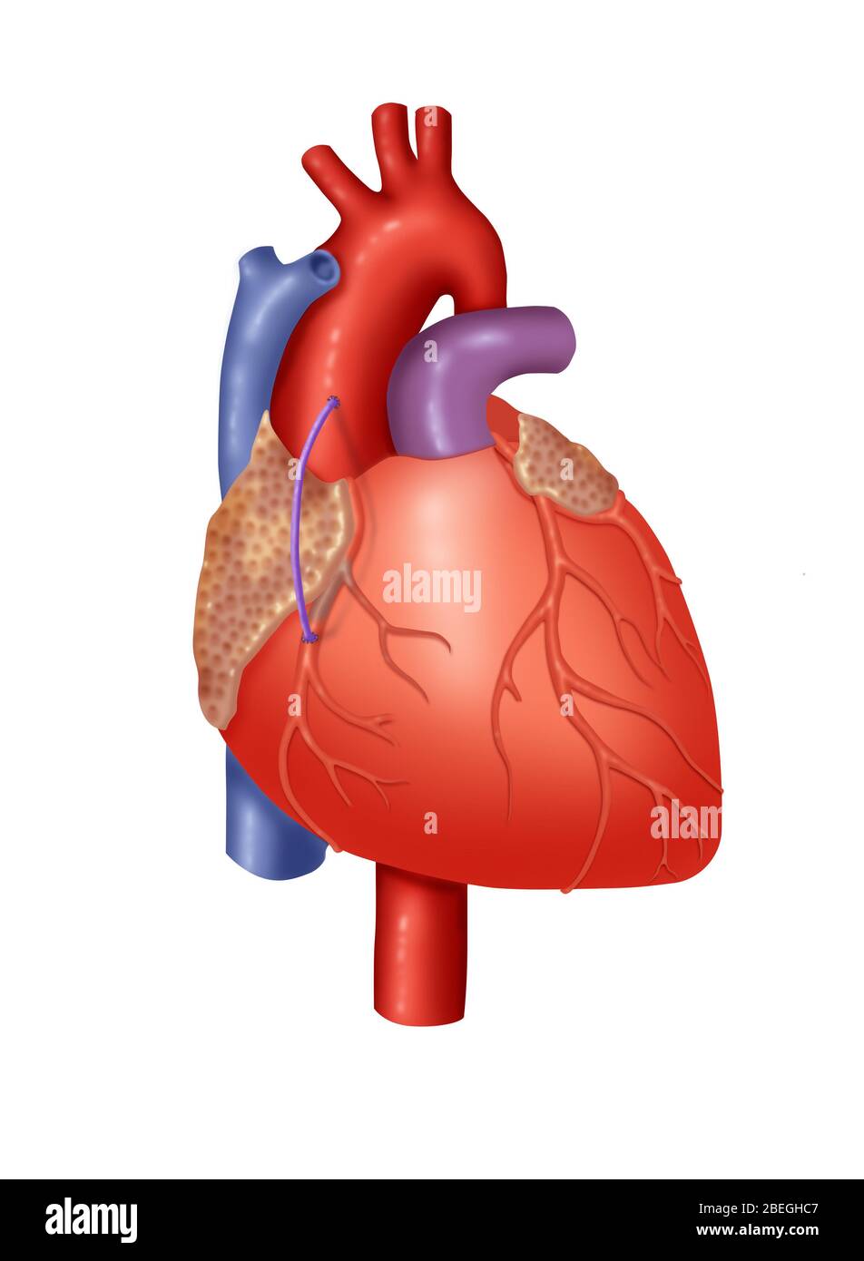 Koronarvene Graft Stockfoto
