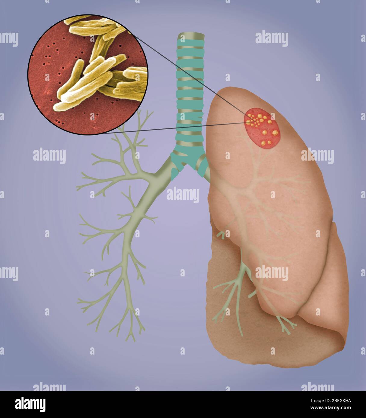 Tuberkulose mit Granulomen Stockfoto