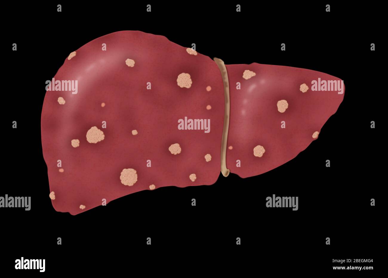Leberzirrhose Im Stadium 2 Stockfoto