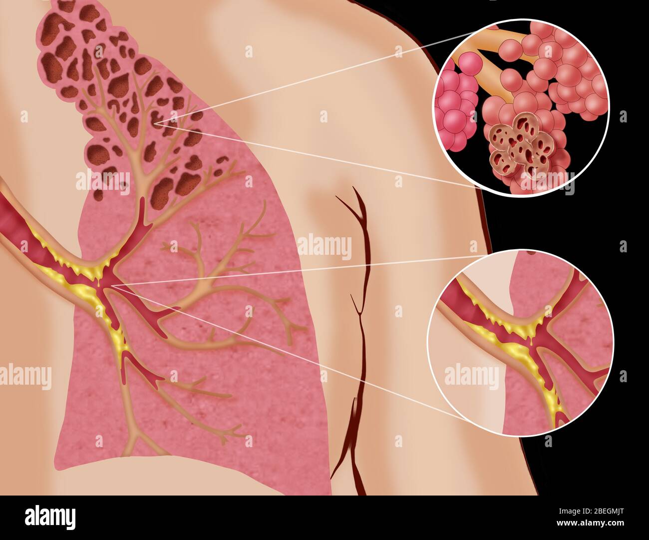 Chronisch obstruktive Lungenerkrankung (COPD) Stockfoto