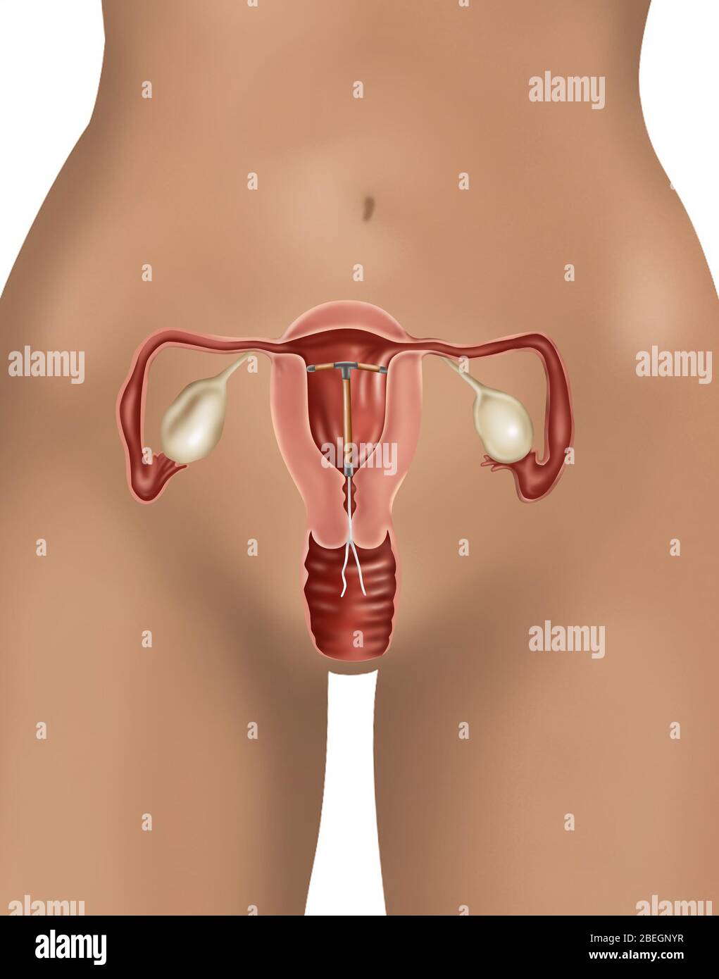 IUD-Verhütungsmittel Stockfoto