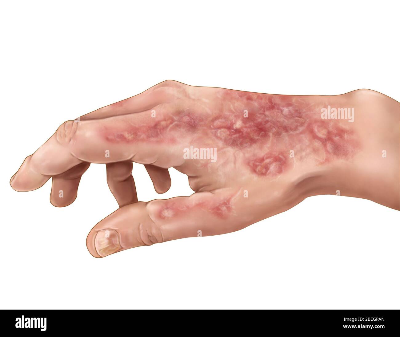 Schwere Psoriasis Stockfoto