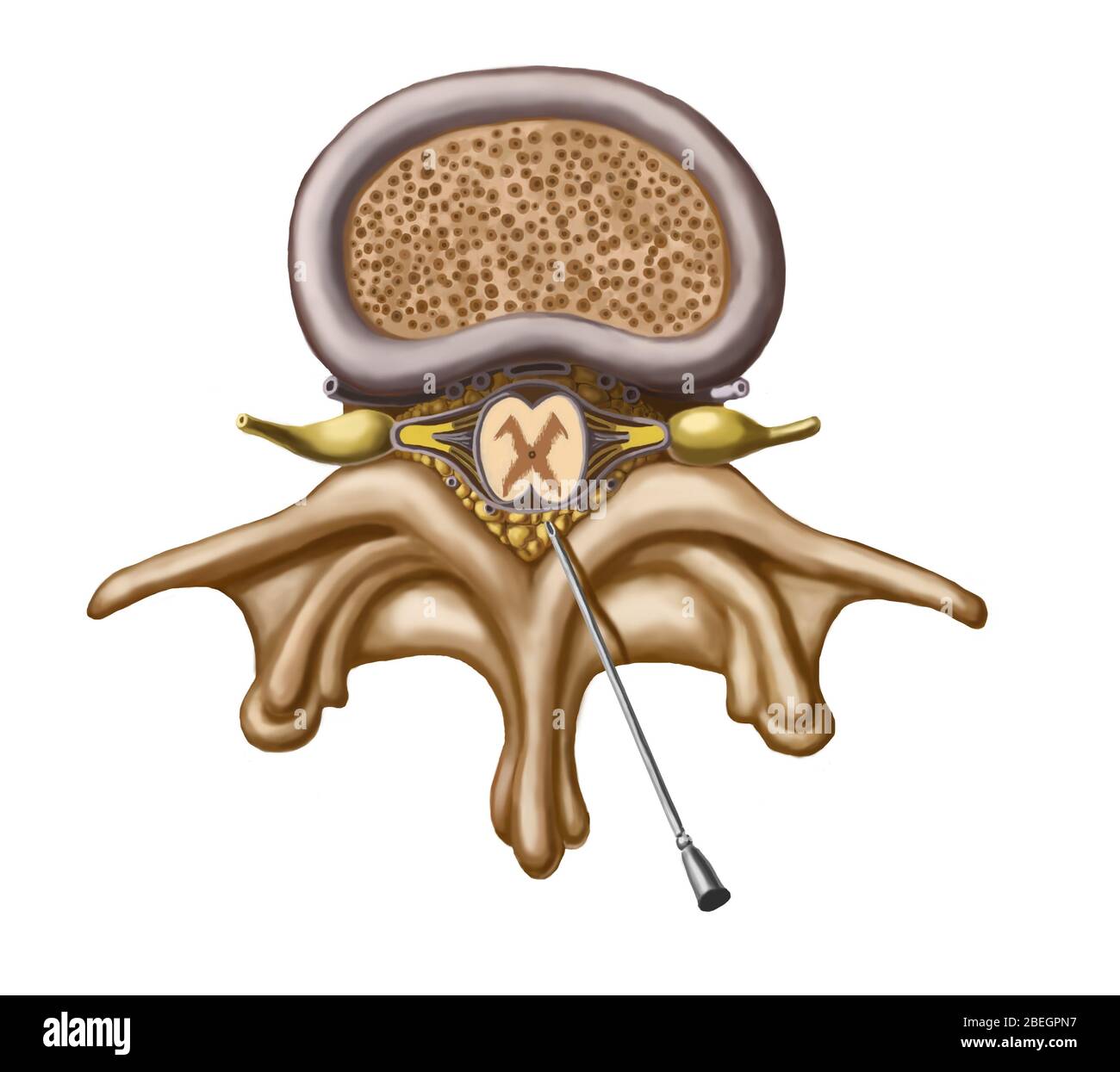 Spinal Tap Stockfoto