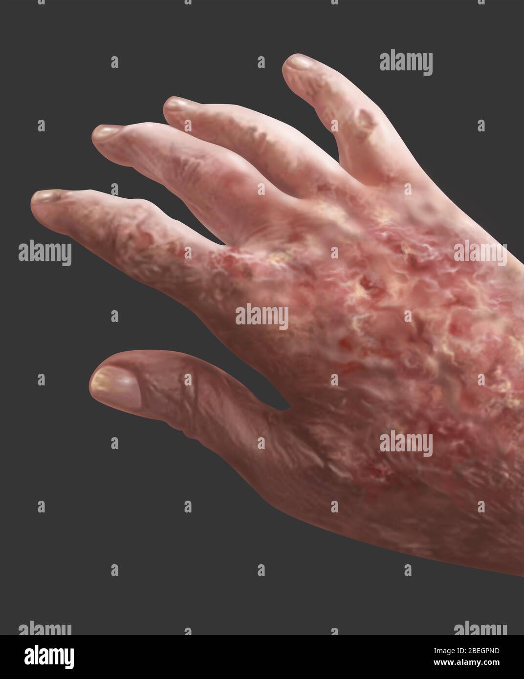 Schwere Psoriasis Stockfoto