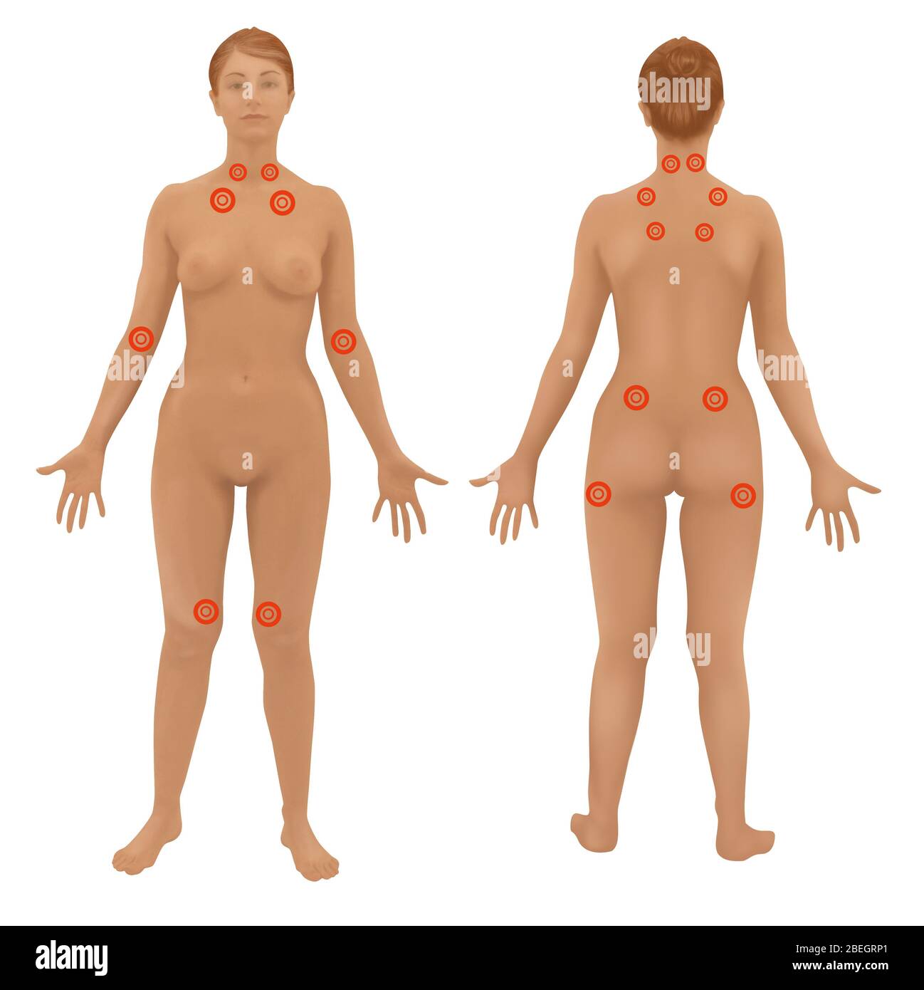 Fibromyalgie Stockfoto