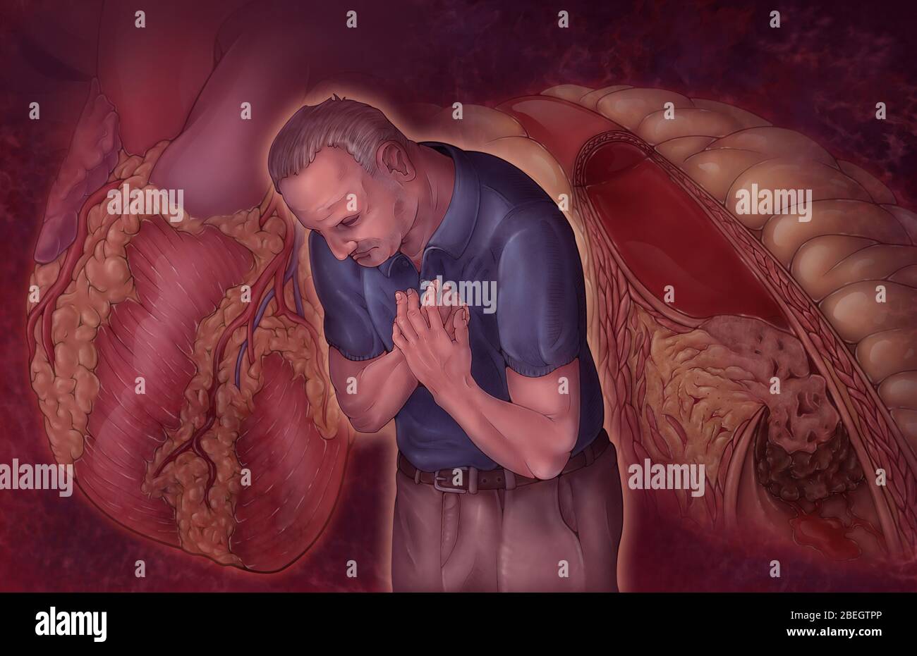 Illustration Zum Herzinfarkt Stockfoto