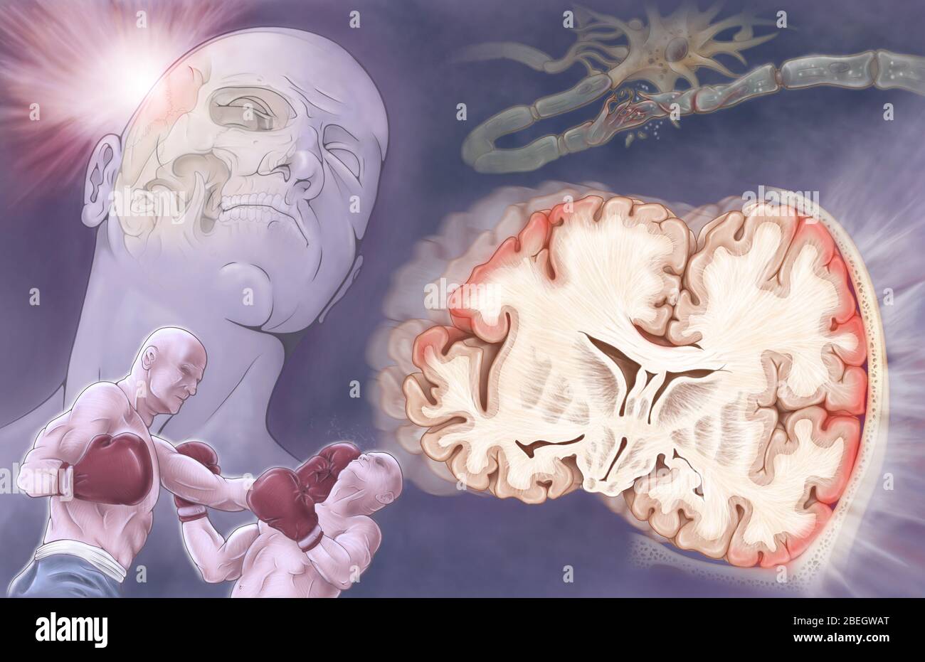 Traumatische Hirnverletzung Stockfoto