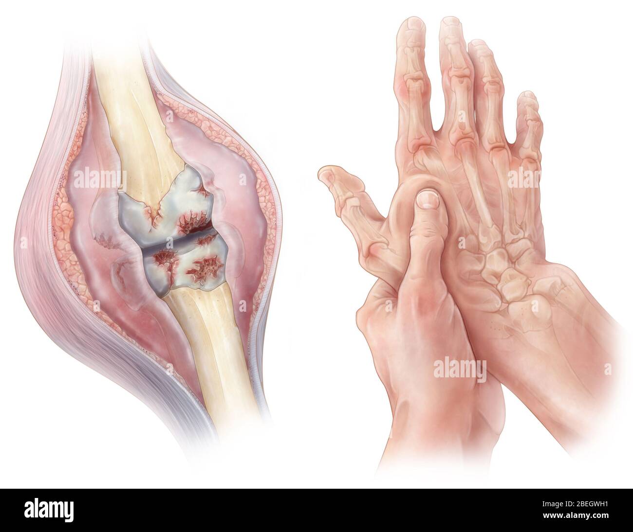 Rheumatoide Arthritis Stockfoto