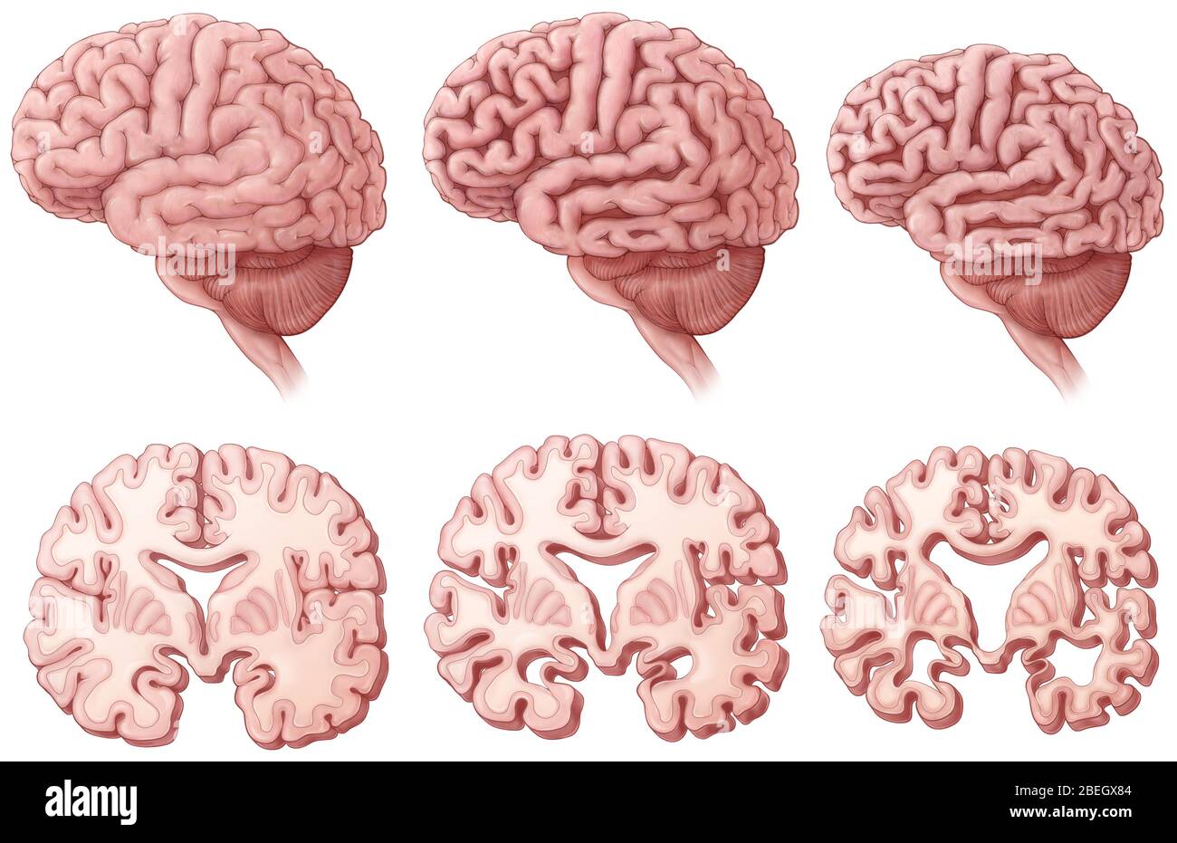 Alzheimer-Krankheit Fortschreiten Stockfoto