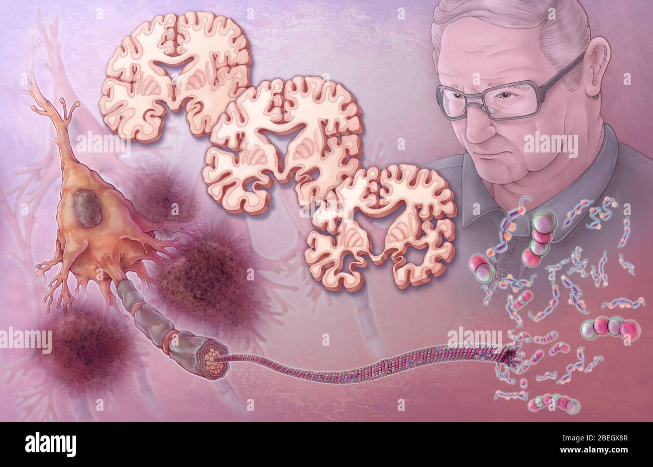 Alzheimer-Krankheit Pathologie Stockfoto