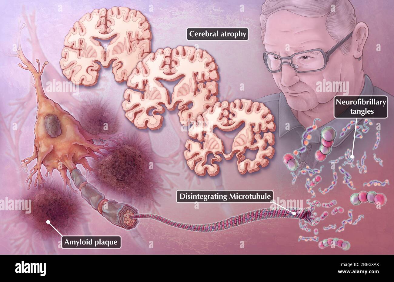 Alzheimer-Krankheit Neuropathologie Stockfoto