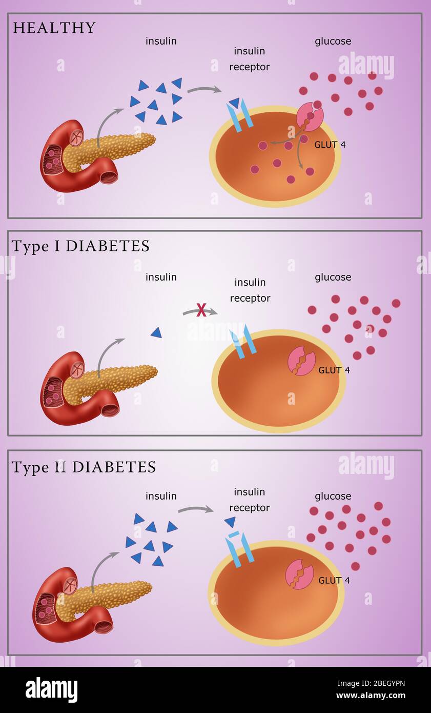 Diabetes I und II Stockfoto