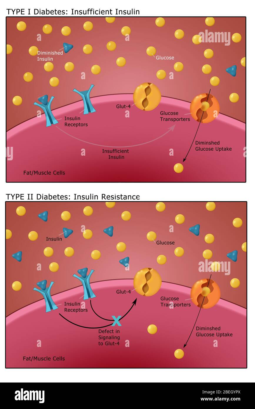 Diabetes I und II Stockfoto