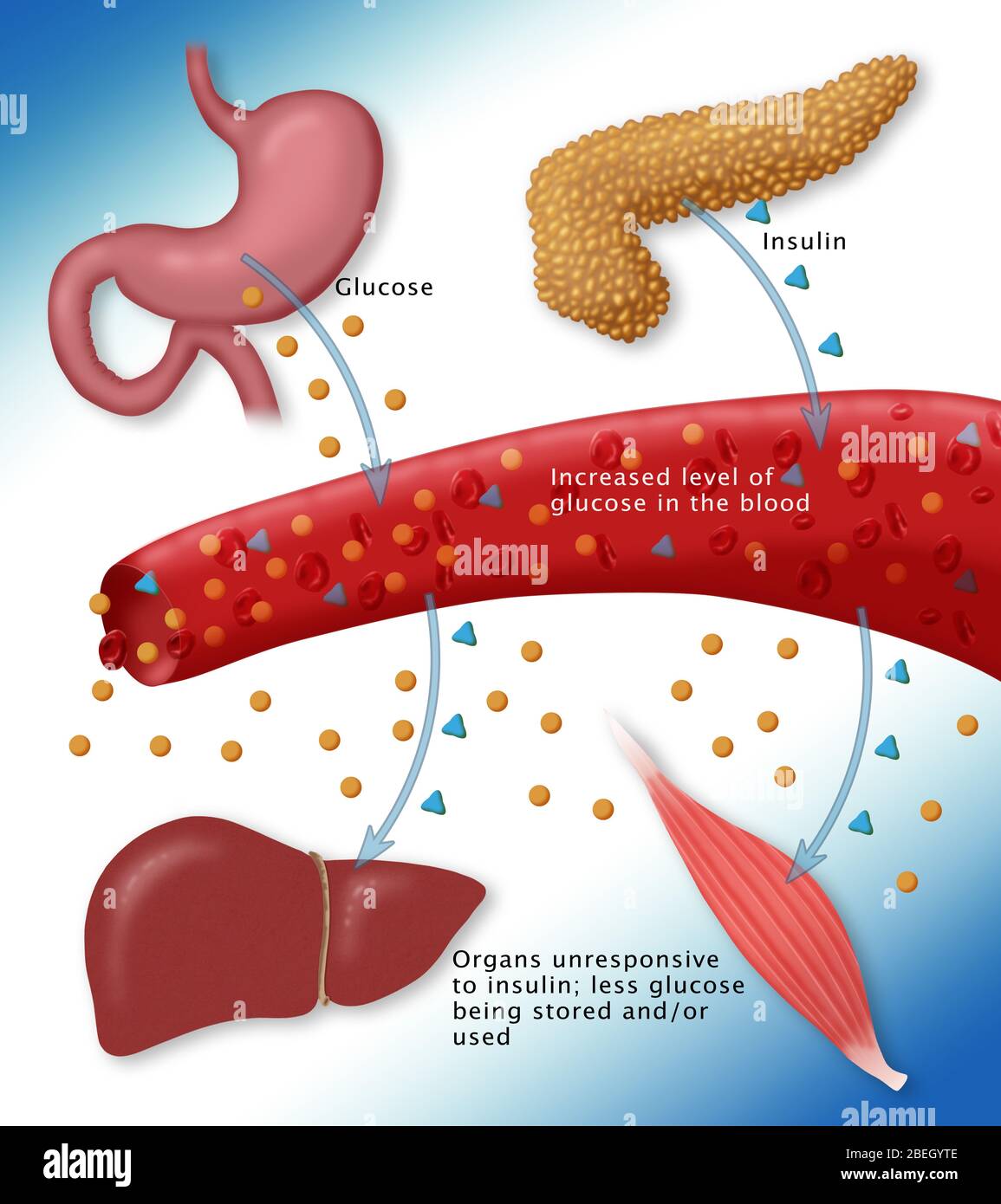 Typ-II-Diabetes Stockfoto