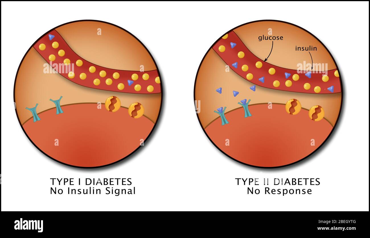 Diabetes I und II Stockfoto