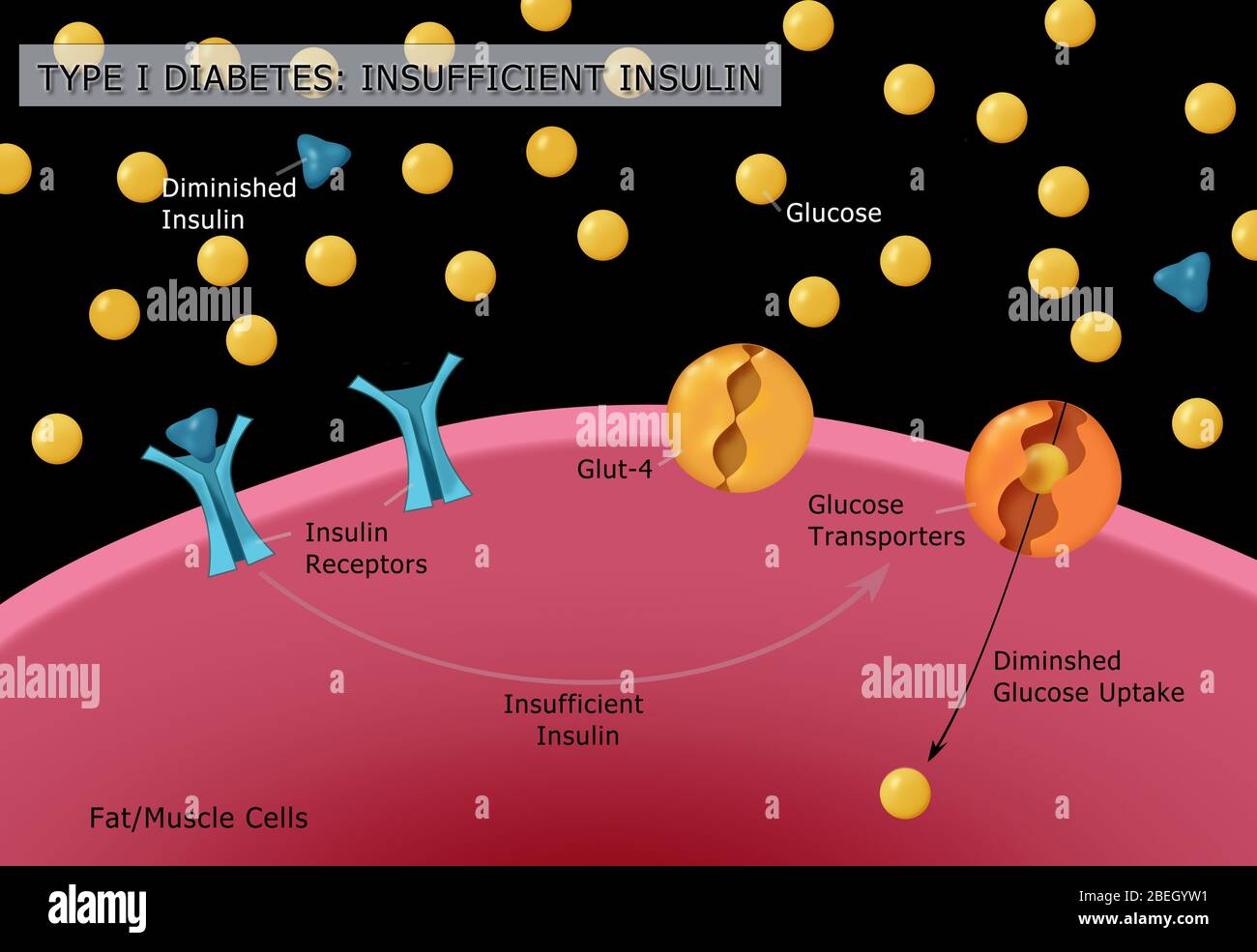 Typ-I-Diabetes Stockfoto