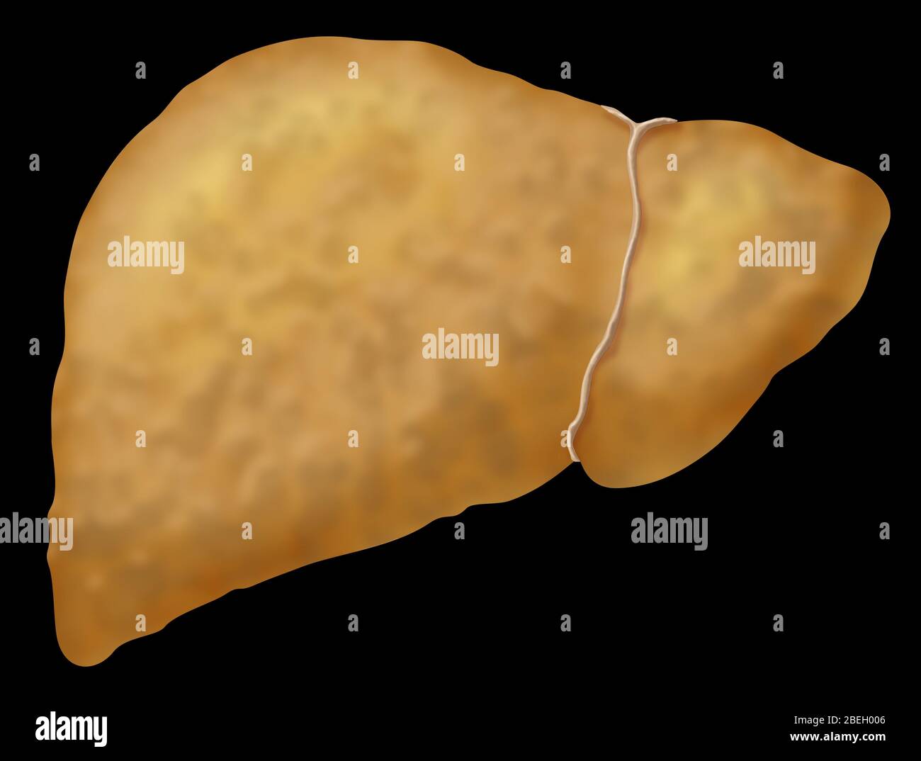 Fatty Liver Disease Stockfoto