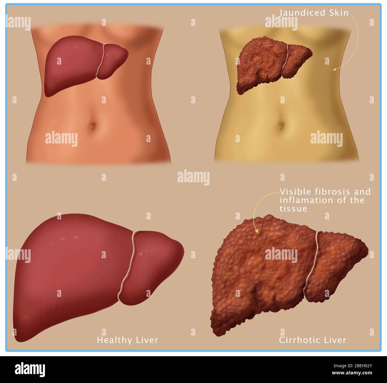 Gesunde vs. Zirrhotische Leber Stockfoto